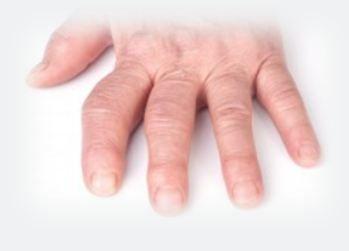 BMD Loss Predicts Joint Damage in Rheumatoid Arthritis