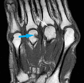 Baseline Bone Erosions Are Prognostic Signs in RA