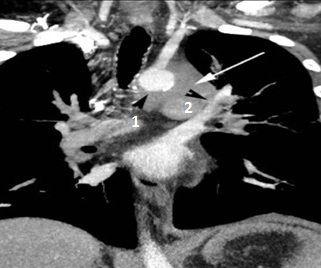 Man With Chest and Shoulder Pain, Cough, and Mediastinal Mass