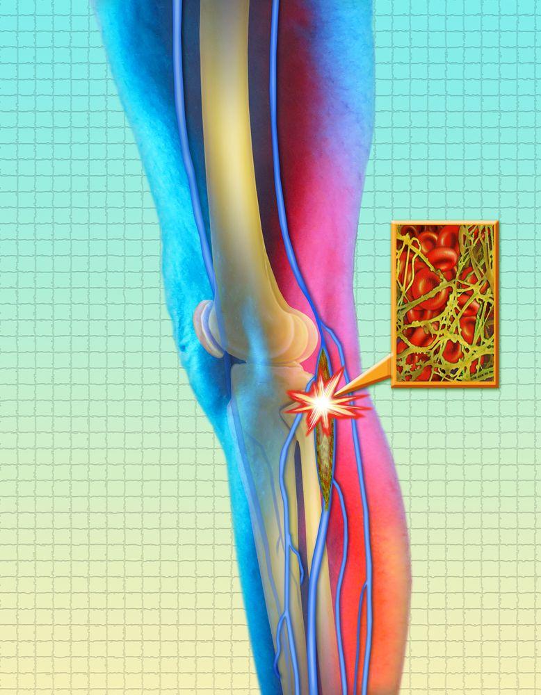 Dangerous Clot Risks Higher in SSc