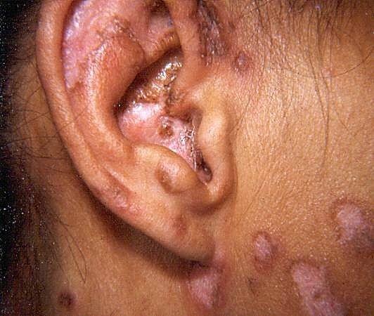 Hypopigmented Lesions on a Young Dark-Skinned Face