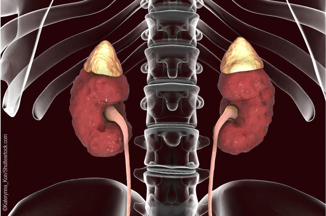 Pheochromocytoma