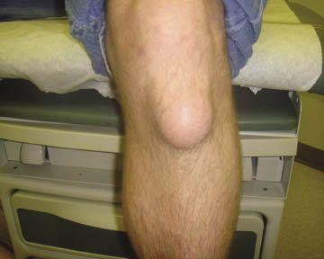 A Floor-Tile Layer With a Bump on His Knee