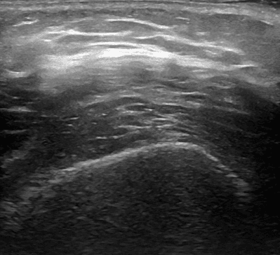 New Scoring System Proposed for Knee Ultrasound