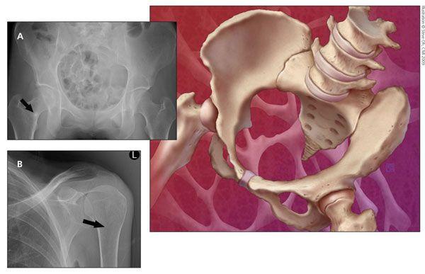 Recognizing the musculoskeletalmanifestations of vitamin D deficiency