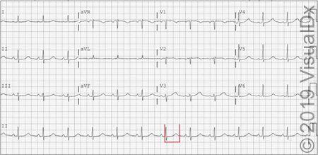 Visual Dx:  Syncope, Seizure and Hypokalemia ...Can You Diagnose This Patient? 