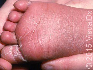 Image IQ: Infant with skin peeling