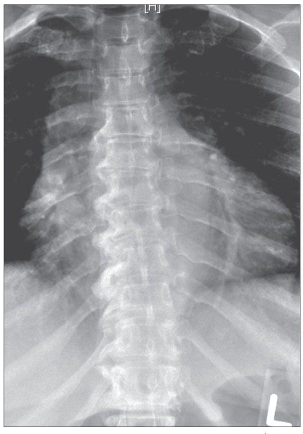 An Unexpected Finding in a Patient With Osteoarthritis