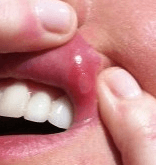 Apremilast Reduces Oral Ulcers in Behçet Syndrome