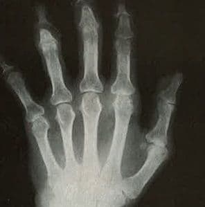 PsA? OA? Cases of Joint Confusion 