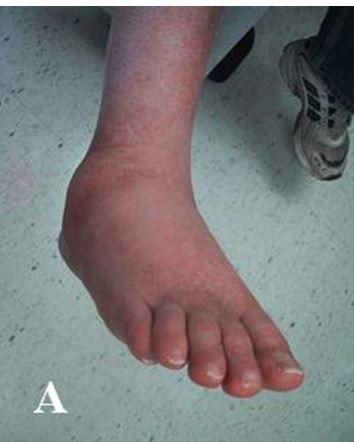 Charcot Neuroarthropathy: A Major Cause of Morbidity in Diabetes