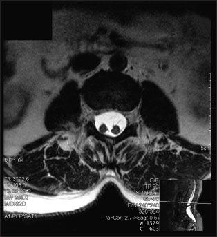 A Woman With "Life-Long" Low Back Pain