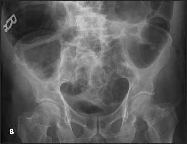 intestinal pseudo-obstruction