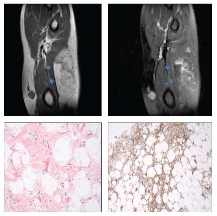 Elbow Mass in a 52-Year-Old Man With RA