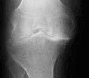 knee OA