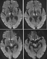 Endocarditis: Infection, Antiphospholipid Syndrome, or Something Else?