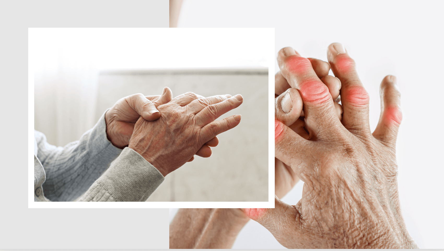 Baricitinib Lowers Structural Joint Damage in Patients With Rheumatoid Arthritis 