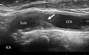 RA and Carotid Plaques:  Five Things to Know