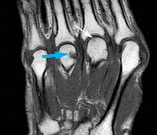 Imaging the Earliest Signs of Rheumatoid Arthritis