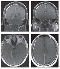 Persistent Headache in a Patient With RA