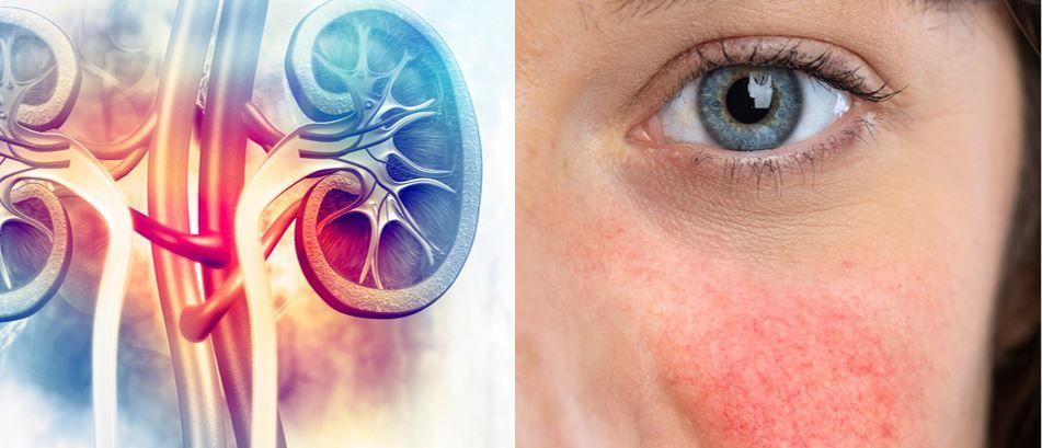 Phenotypes in SLE: Can They Predict Characteristic, Disease Outcomes and Treatment Needs?