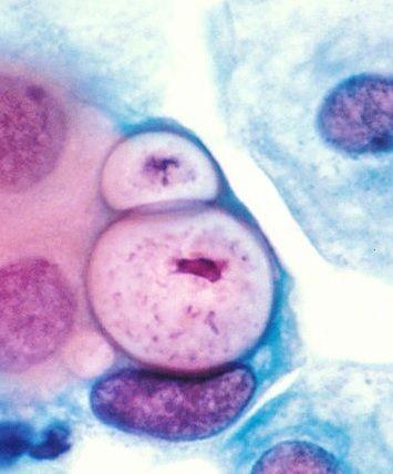 Chlamydia trachomatis