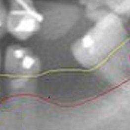 Dental Issues (Not Opening Wide ... ) a Severity Indicator in SSc