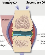 osteoarthritis