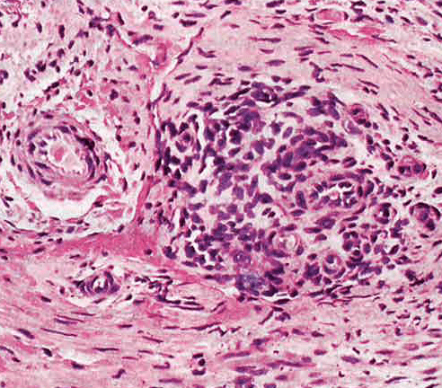 giant cell arteritis