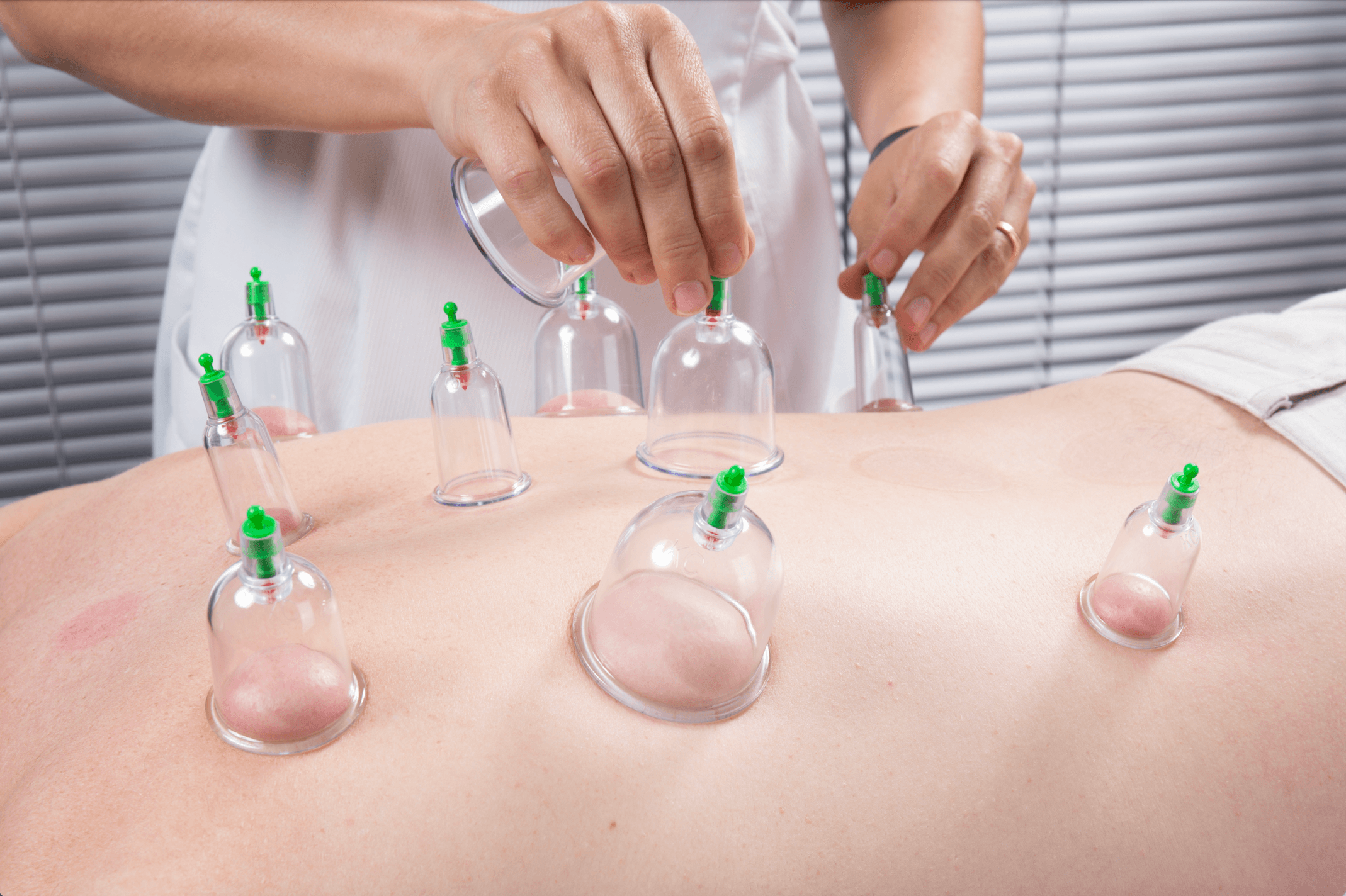 Cupping Therapy Eases Migraine Pain but Fails to Enhance Quality of Life