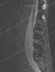 ankylosing spondylitis