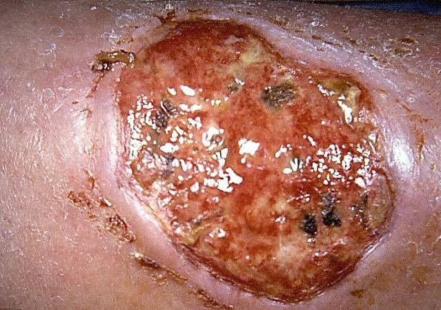 Painful Leg Ulcer in Seropositive RA