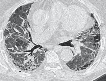 Interstitial Pneumonia? Rheumatic Disease Has Better Odds Than Idiopathic