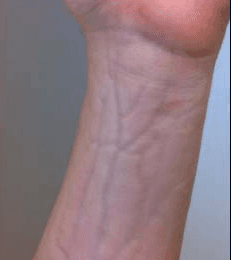 Lancet Case Report: Grooves Around the Veins