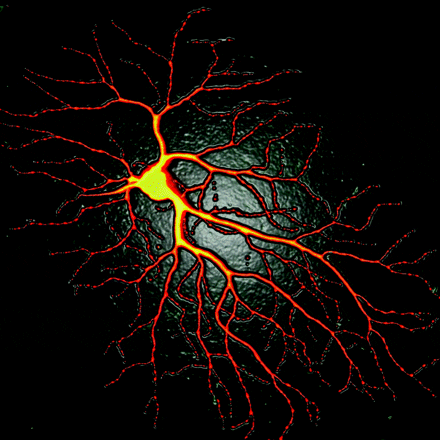 ALS Research: Skin Cells Turned into Nerve Cells