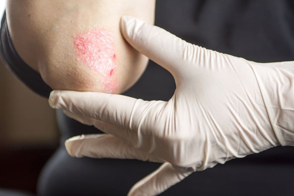 Psoriasis (©Hriana/Shutterstock.com)