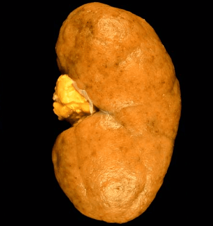 lupus nephritis