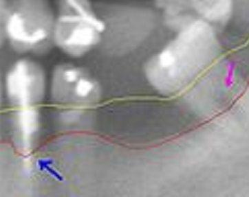 periodontal disease