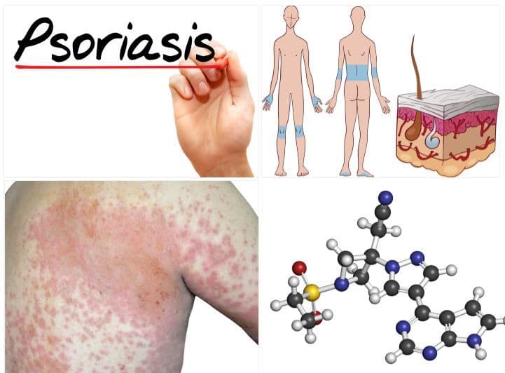 Biologics for Moderate to Severe Plaque Psoriasis and Psoriatic Arthritis