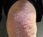 Psoriasis Severity Tied to Death Risk