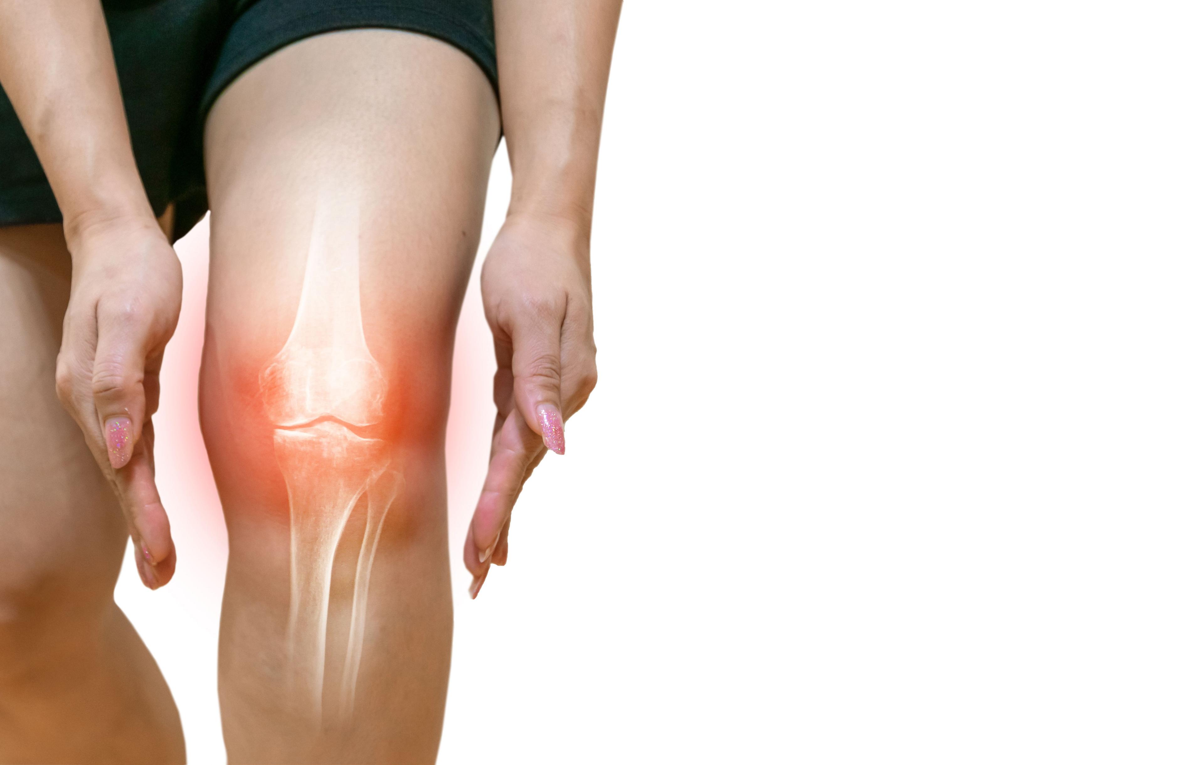 Gene Therapy Improves Pain Management and Disease Progression for Osteoarthritis