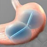 Novel Non-Surgical Temporary Balloon Device Approved for Obesity Treatment