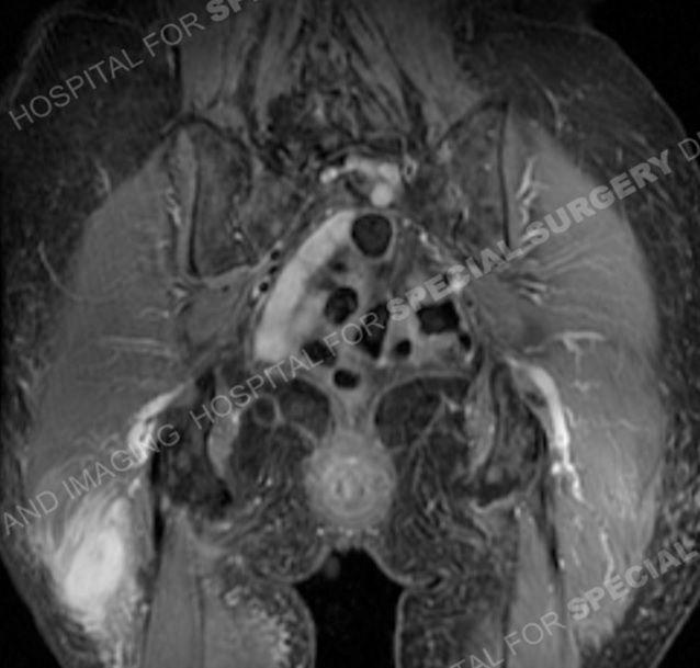 Asymptomatic Mass in Hip of 87-Year-Old Woman