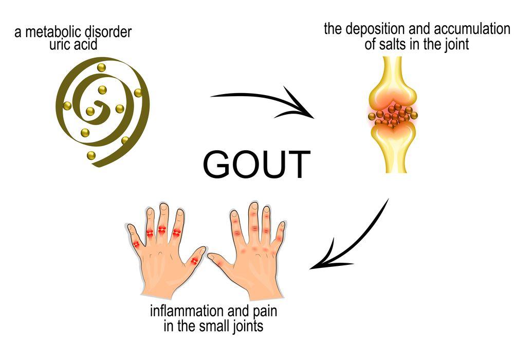 Doctors Don’t Always Agree on Gout’s Origins and Treatment