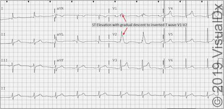 Brugada syndrome