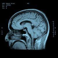 MRIs May Be Able to Detect Patients at Risk for Developing Multiple Sclerosis 