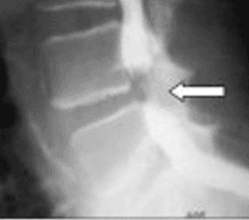 No Benefit of Steroids for Spinal Stenosis in Randomized Trial