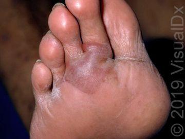 Image IQ:  Diabetes and bulla on the foot