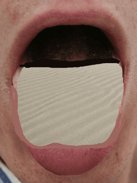 How's Your Sjögren's Patient? Dry Mouth Tells (Nearly) All