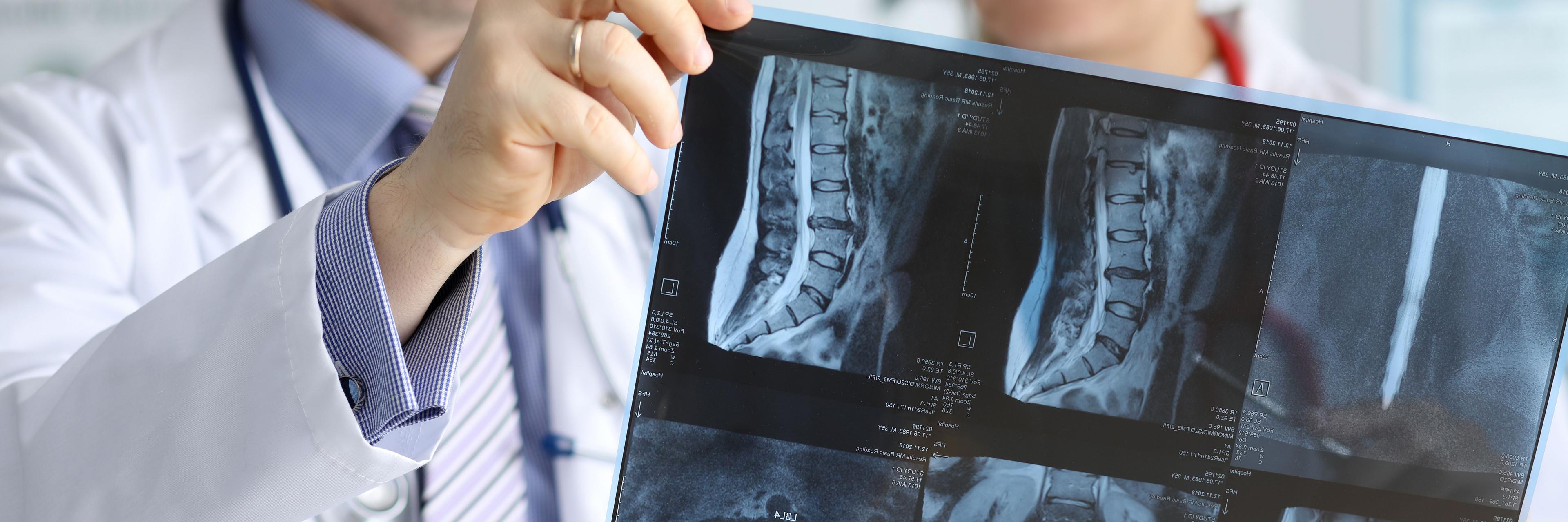 Ixekizumab Improves Fatigue in Patients With Non-Radiographic Axial Spondyloarthritis 